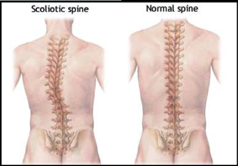 June Is National Scoliosis Awareness Month