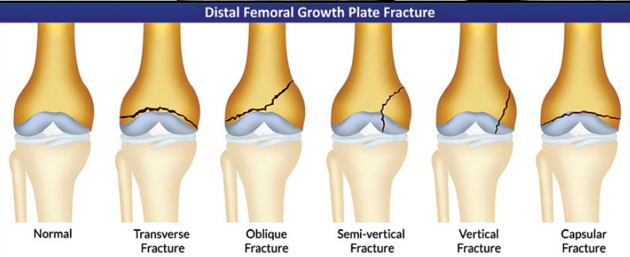 Medical Update – What Is A Growth Plate Fracture?