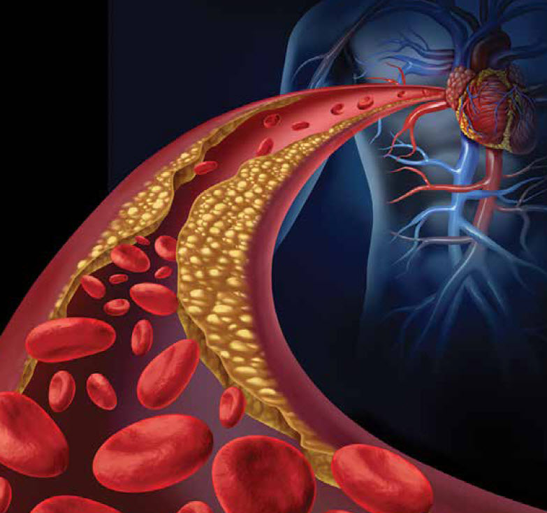 What is Coronary Artery Disease?